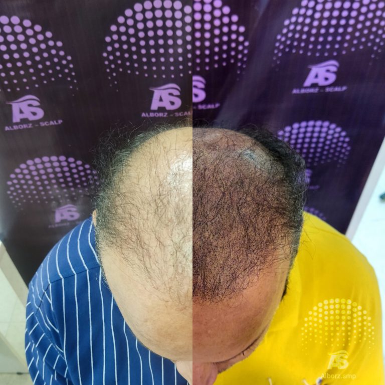 فواید اسکالپ مو چیست؟ فواید اسکالپ مو چیست؟