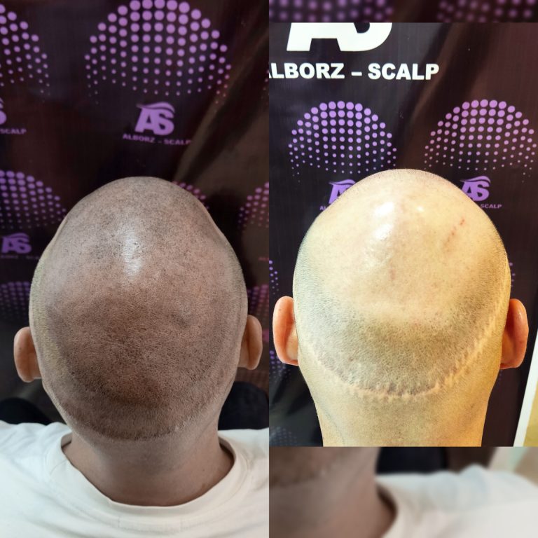 مراقبت های بعد از اسکالپ سر؟! مراقبت های بعد از اسکالپ سر؟!