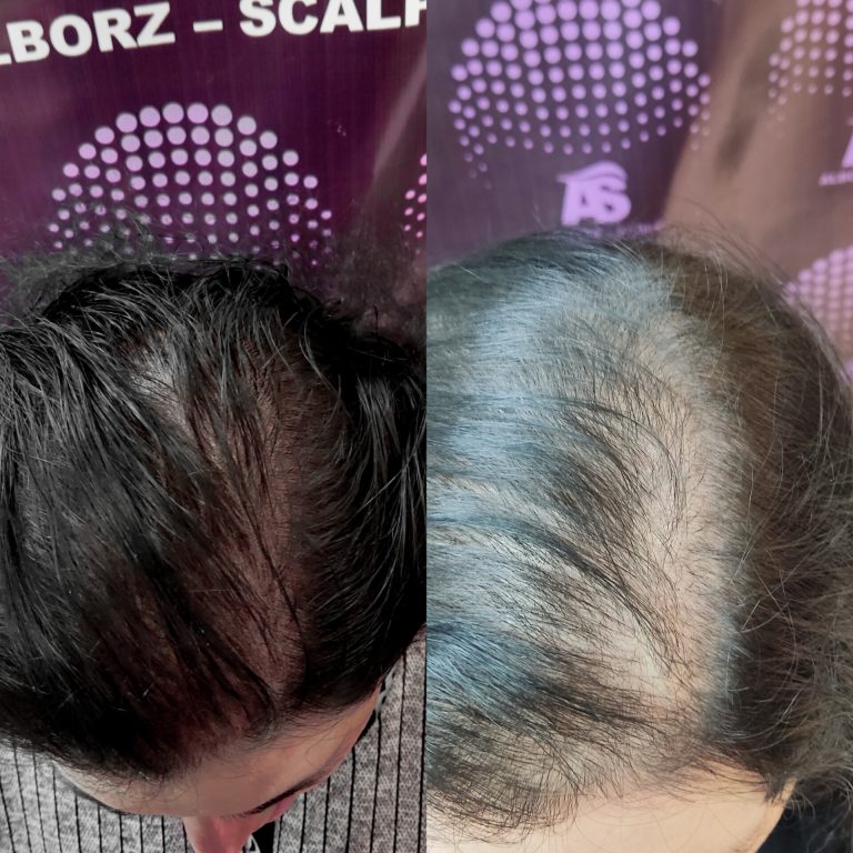 آیا میکروپیگمنتیشن پوست سر باعث رشد مو میشود؟ آیا میکروپیگمنتیشن پوست سر باعث رشد مو میشود؟