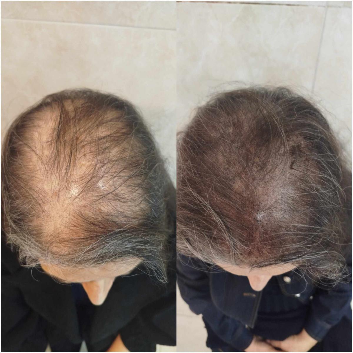 اسکالپ پوششی