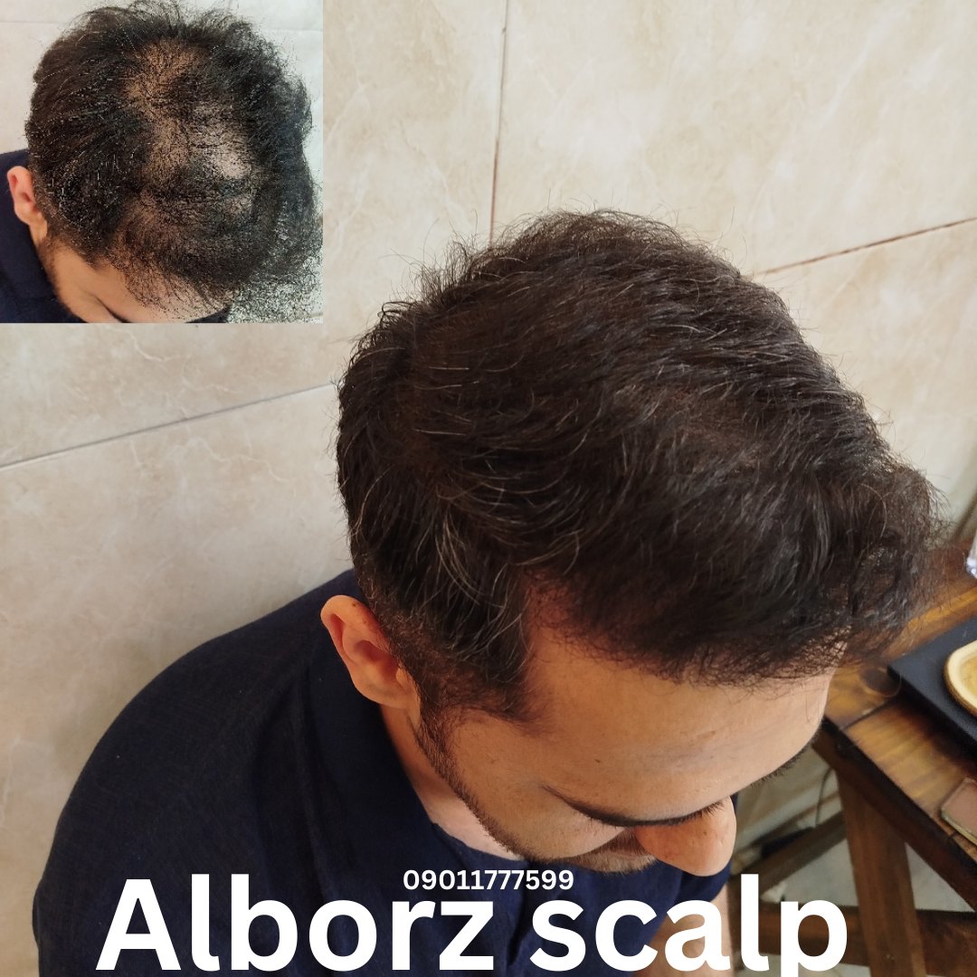 اسکالپ پوششی