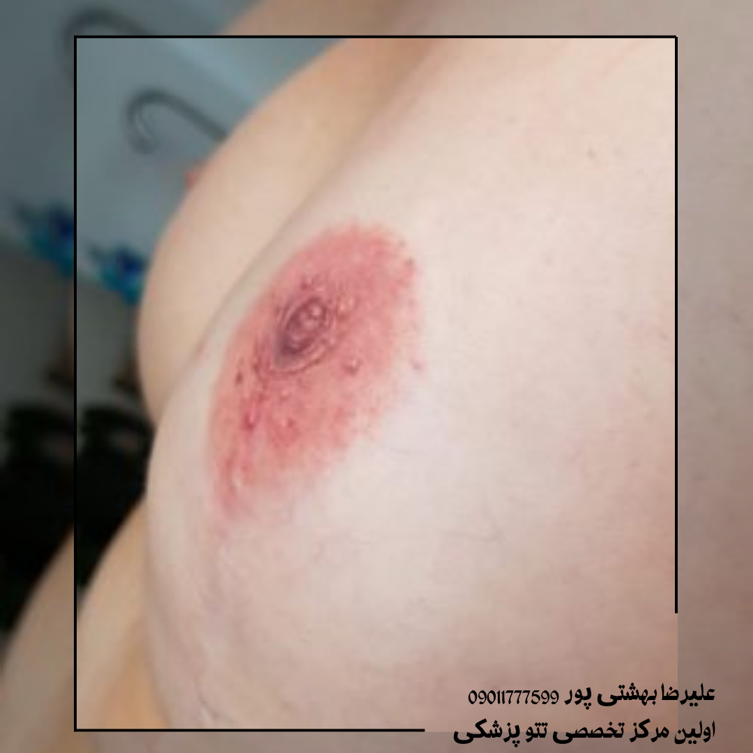 تتو هاله سینه