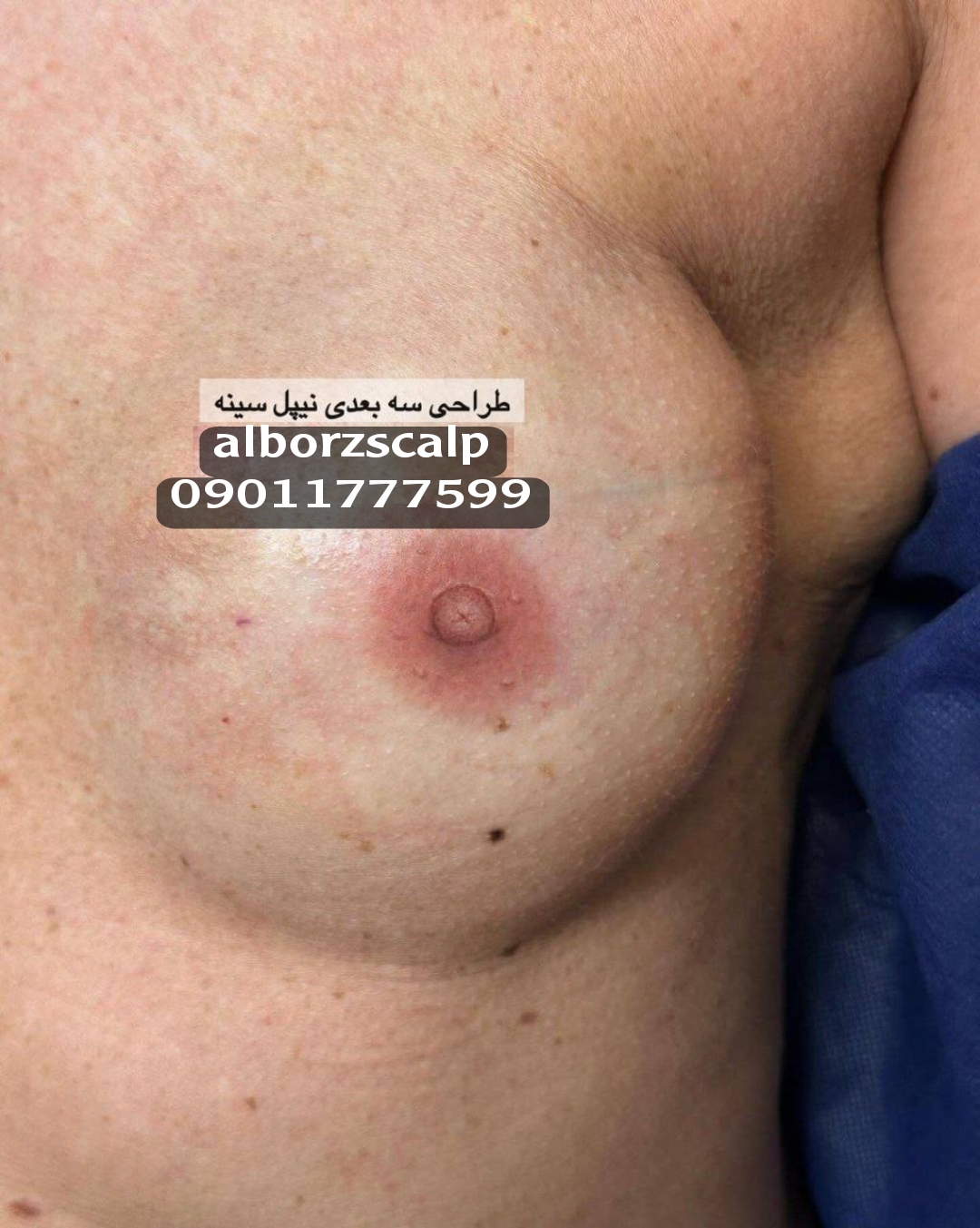 تتو هاله سینه