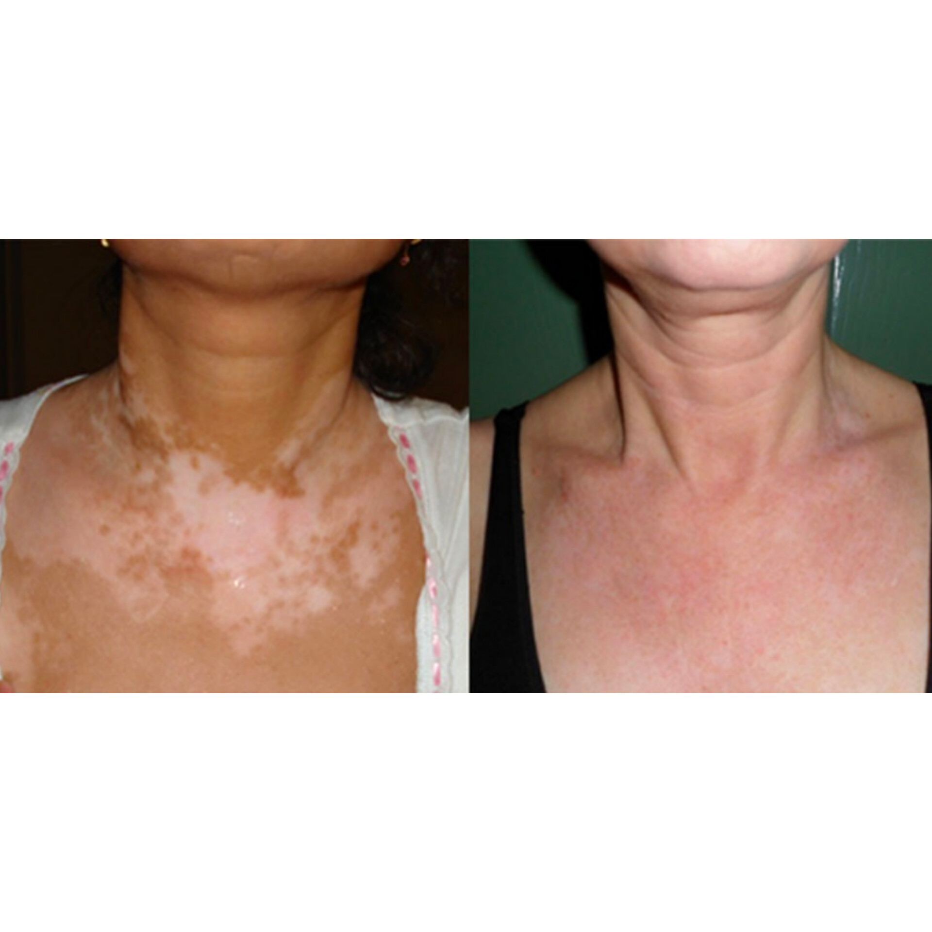 ترمیم ویتیلیگو پیسی برص