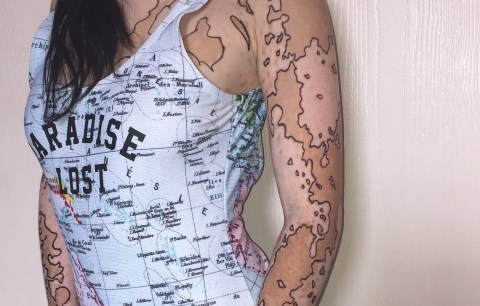 ترمیم ویتیلیگو پیسی برص