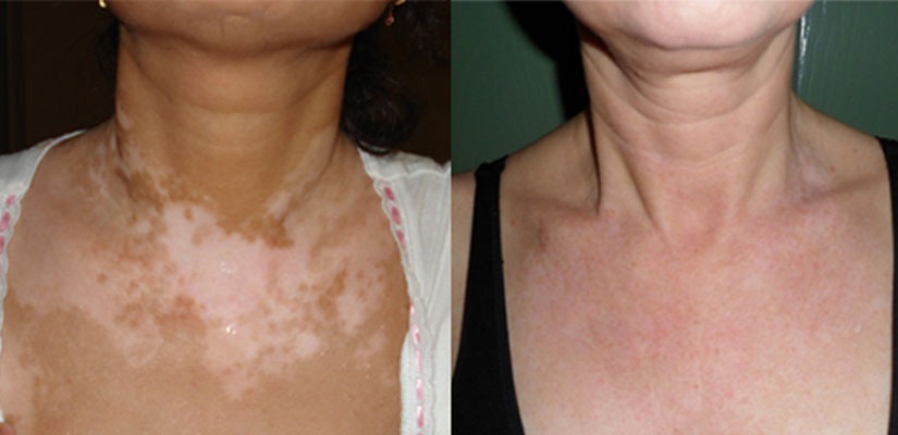 ترمیم ویتیلیگو پیسی برص