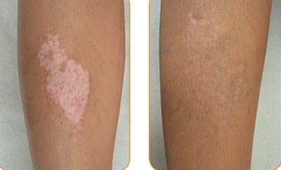 ترمیم ویتیلیگو پیسی برص