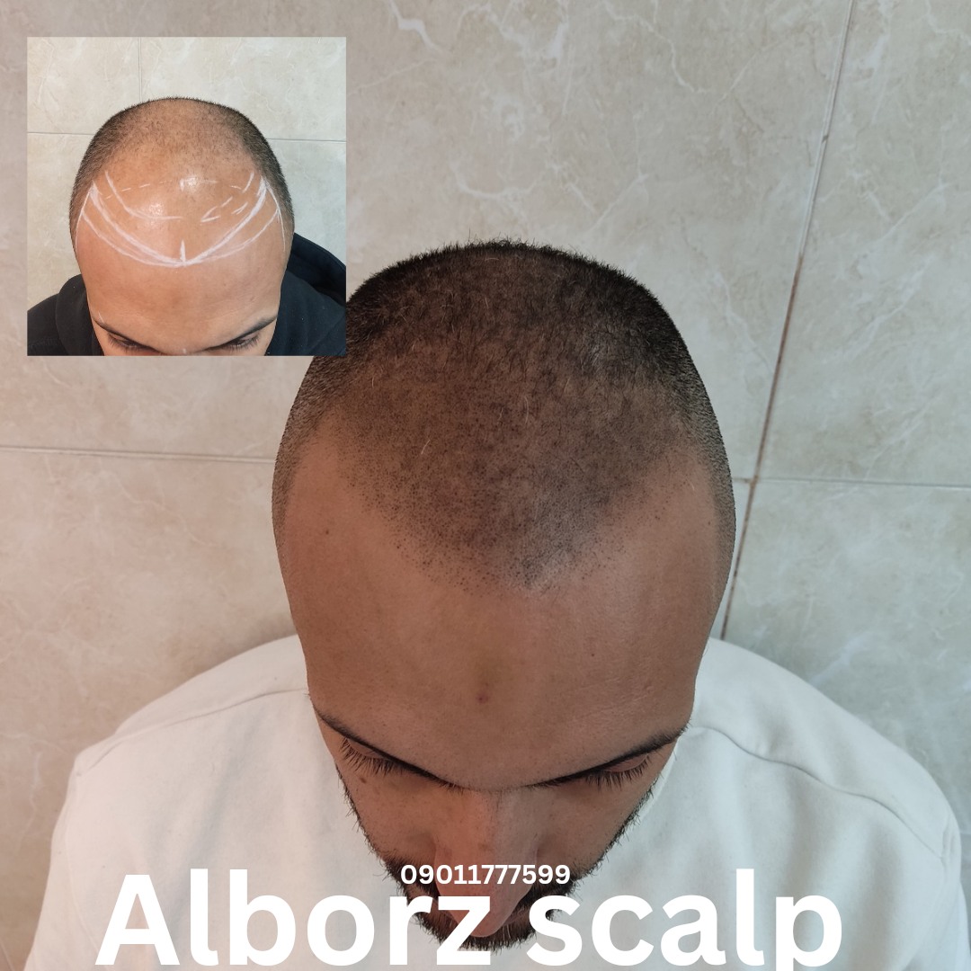 میکرو اسکالپ چیست و دقیقاً چه کاری انجام می‌دهد