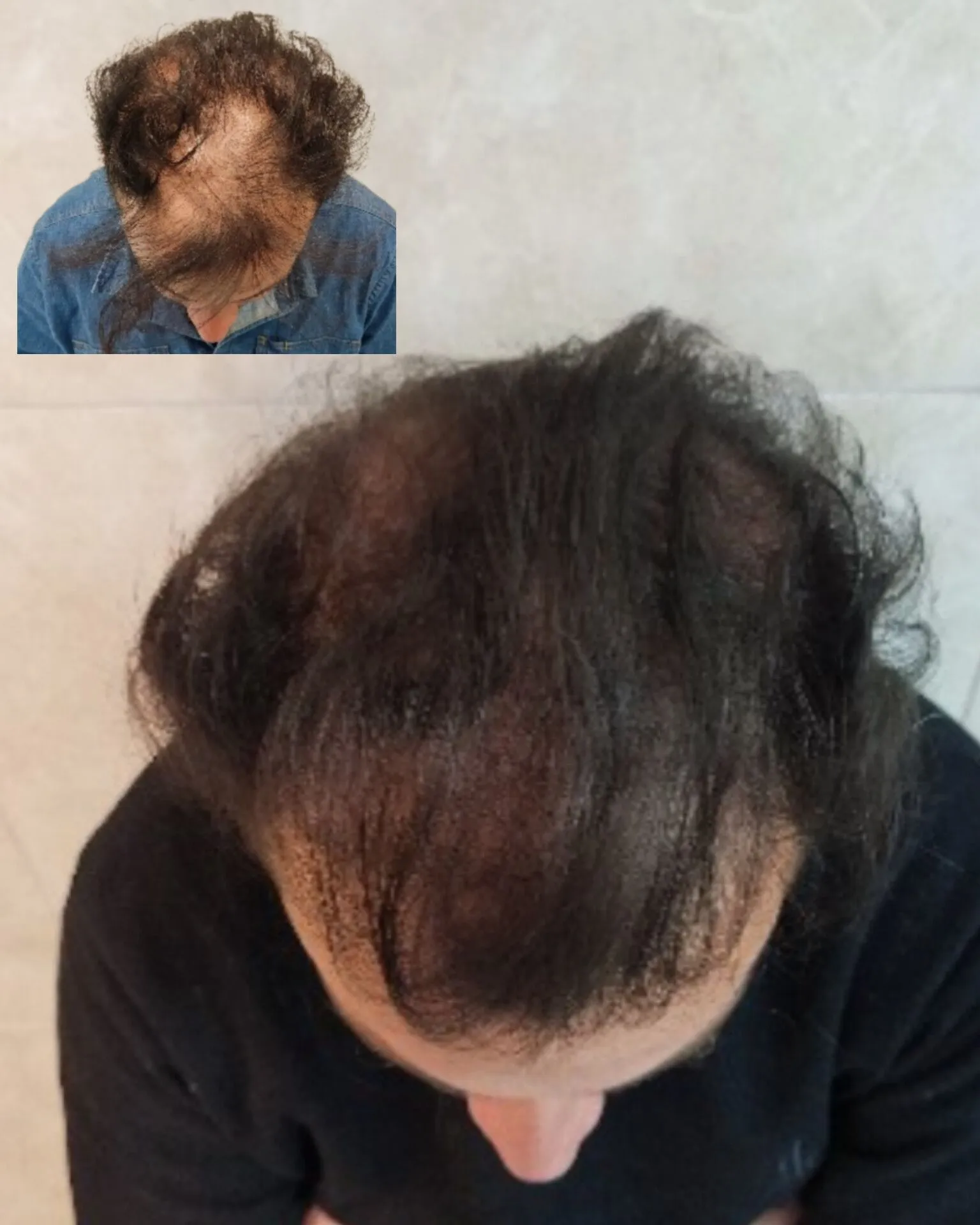 نمونه میکرواسکالپ