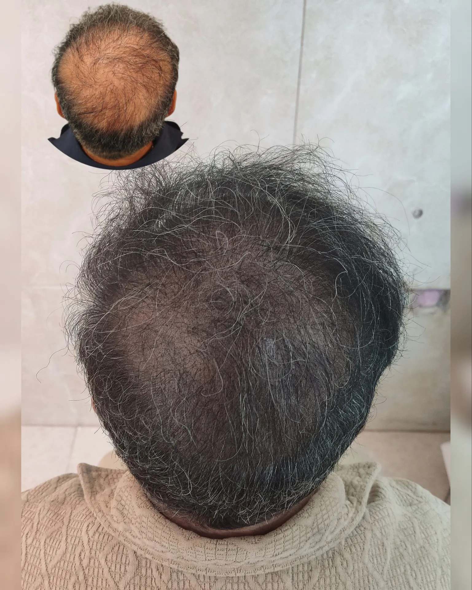 نمونه میکرواسکالپ