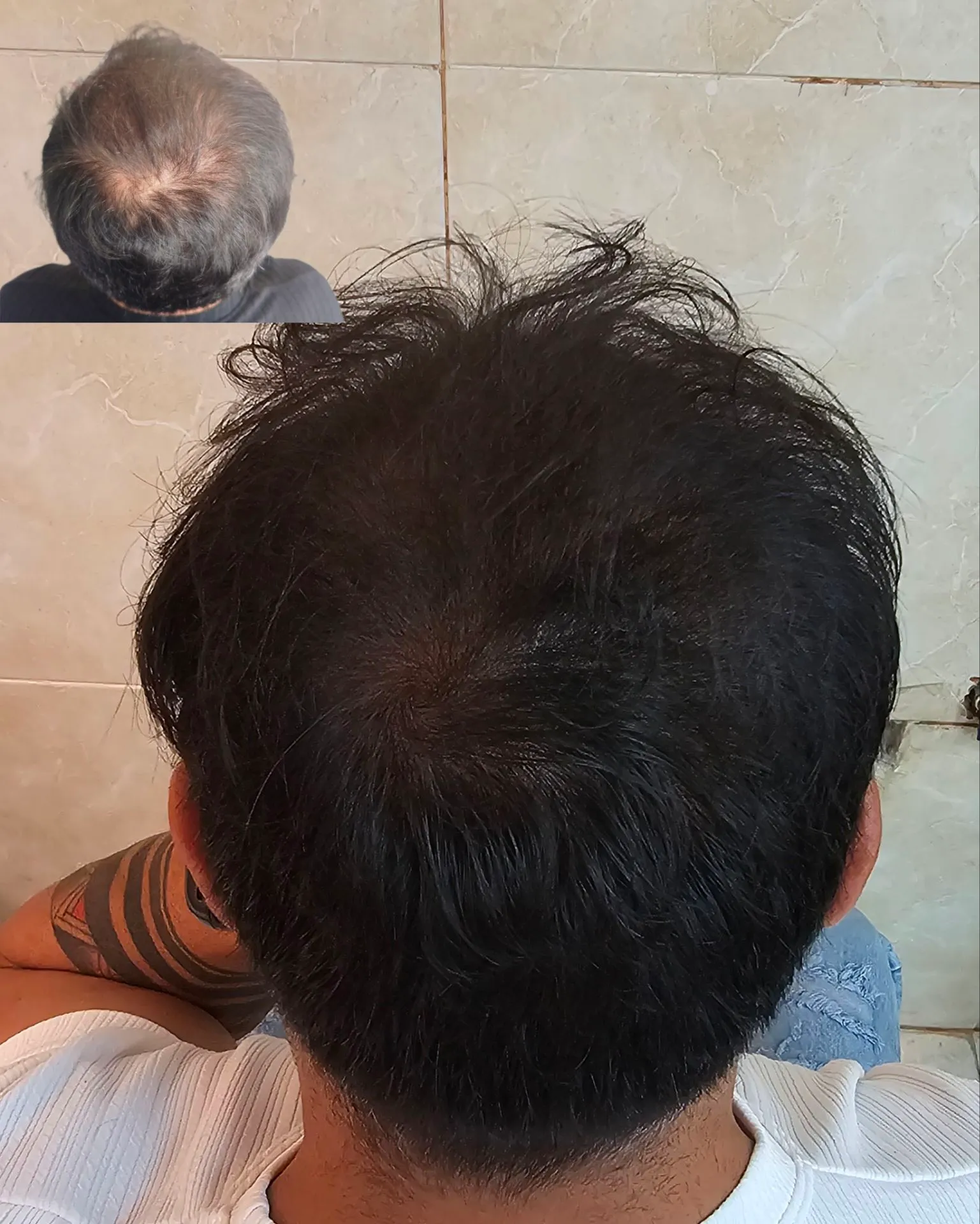 نمونه میکرواسکالپ