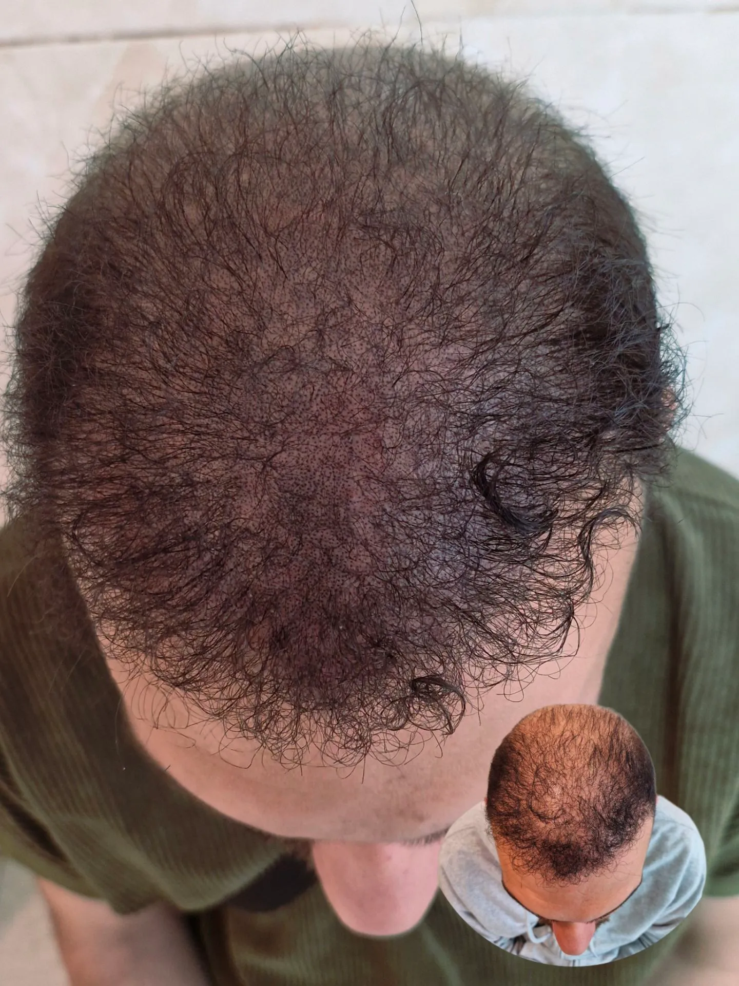 نمونه میکرواسکالپ