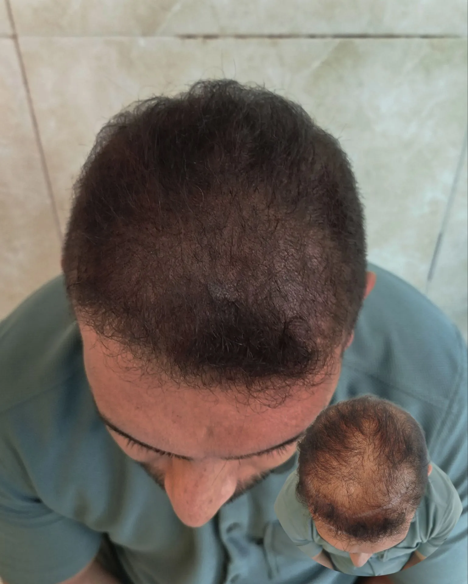 نمونه میکرواسکالپ