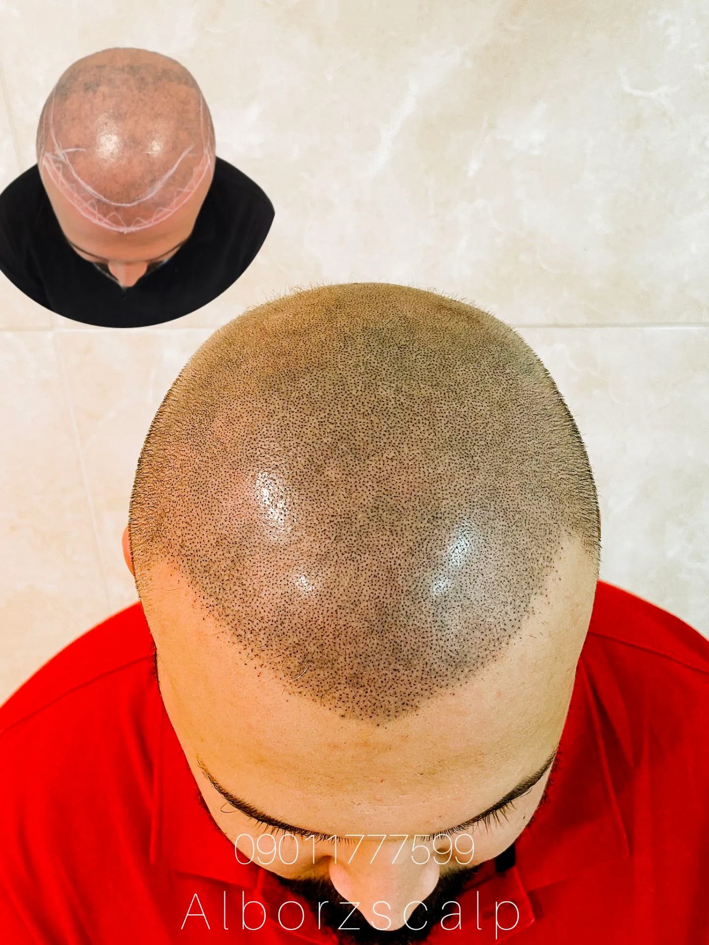 نمونه میکرواسکالپ