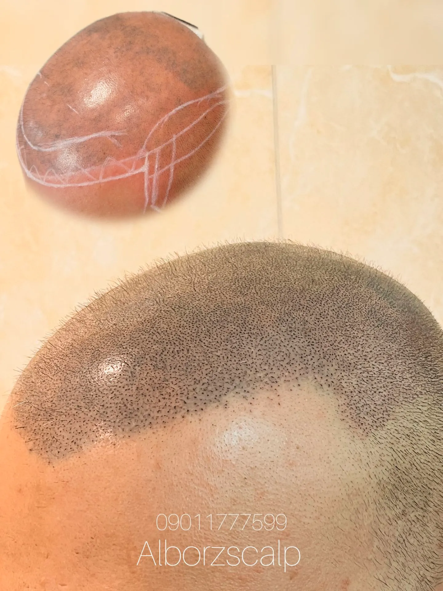 نمونه میکرواسکالپ